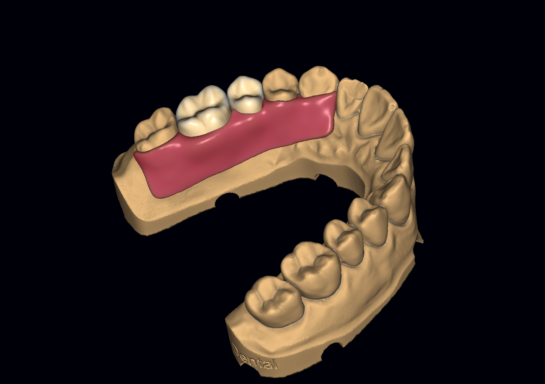 3D Printed Denture